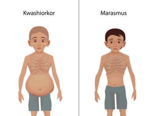 Protein Energy Malnutrition 