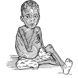 Kwashiorkor 