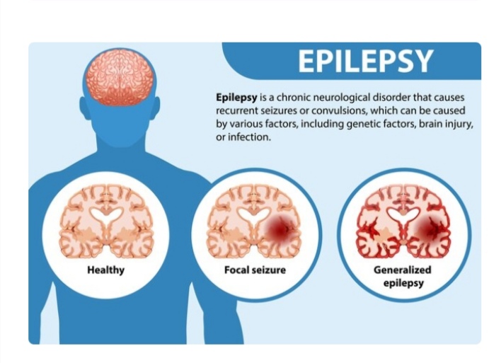 Epilepsy 