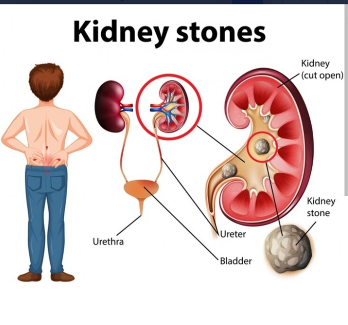 Kidney stones 