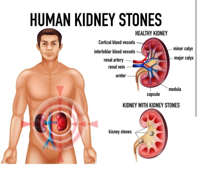 Healthy kidney vs Kidney stones 