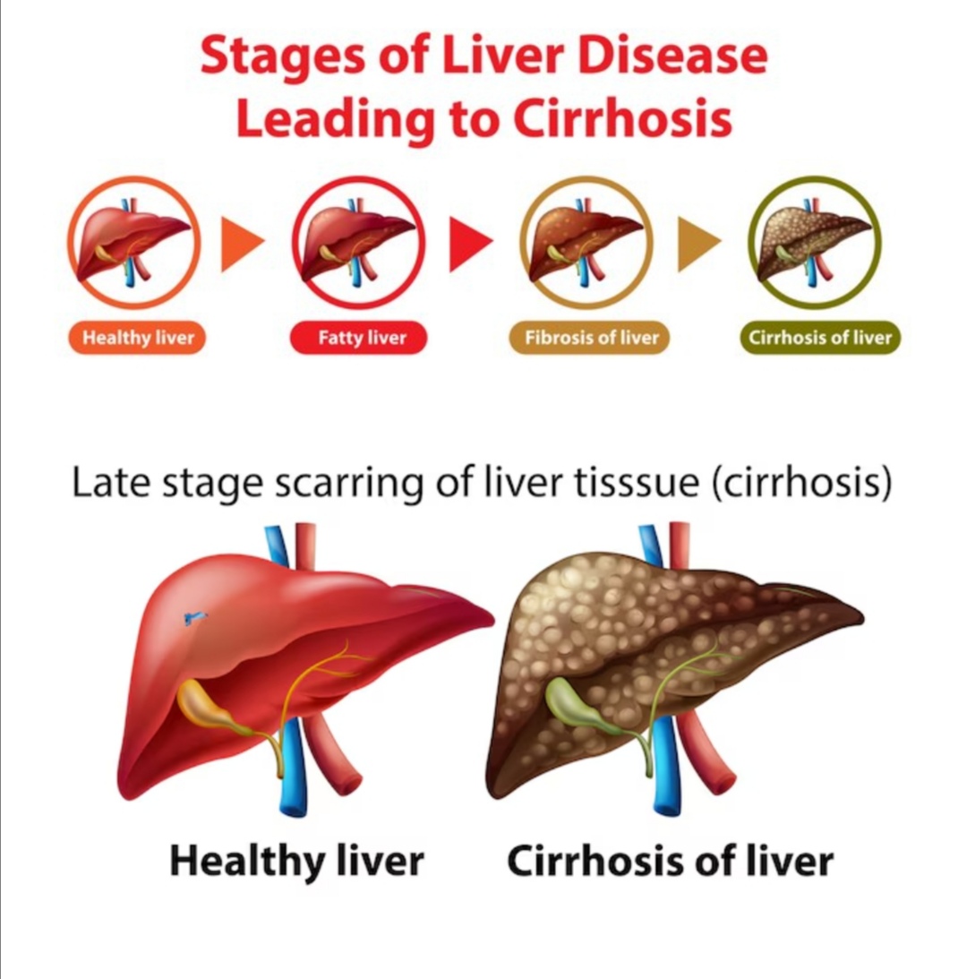 Cirrhosis and it's stages 