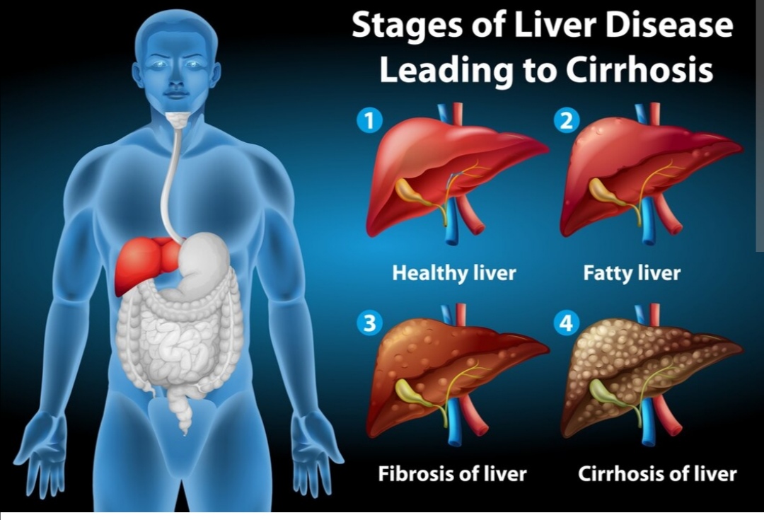 Monitoring and diagnosis liver cirrhosis 